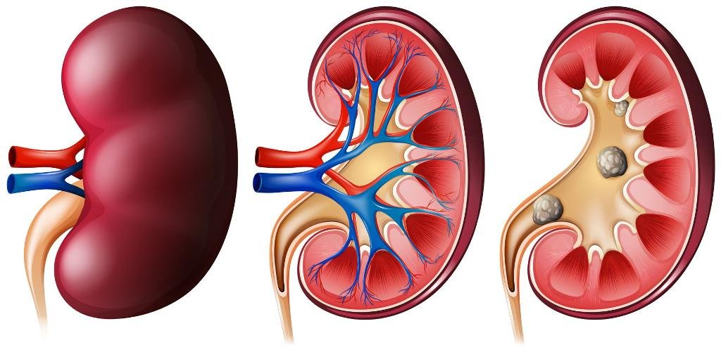 Cálculo renal
