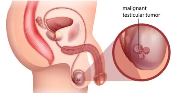 Cáncer urológico
