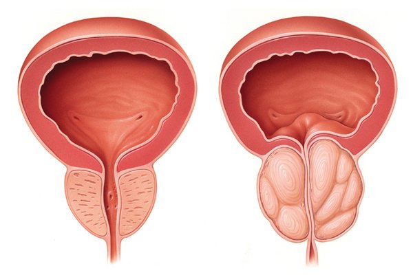 Hiperplasia benigna de próstata